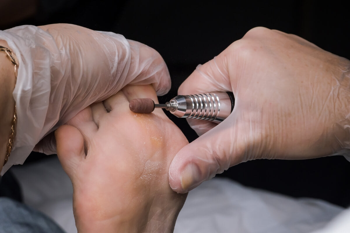 Callosidades y durezas: cuándo son normales y cuándo preocuparse