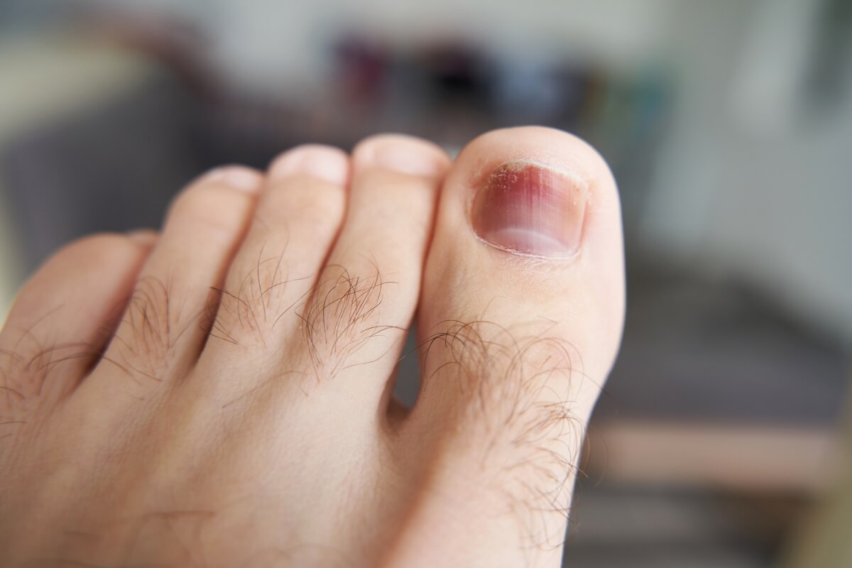 Uñas negras en deportistas: qué son, por qué aparecen y cómo prevenirlas