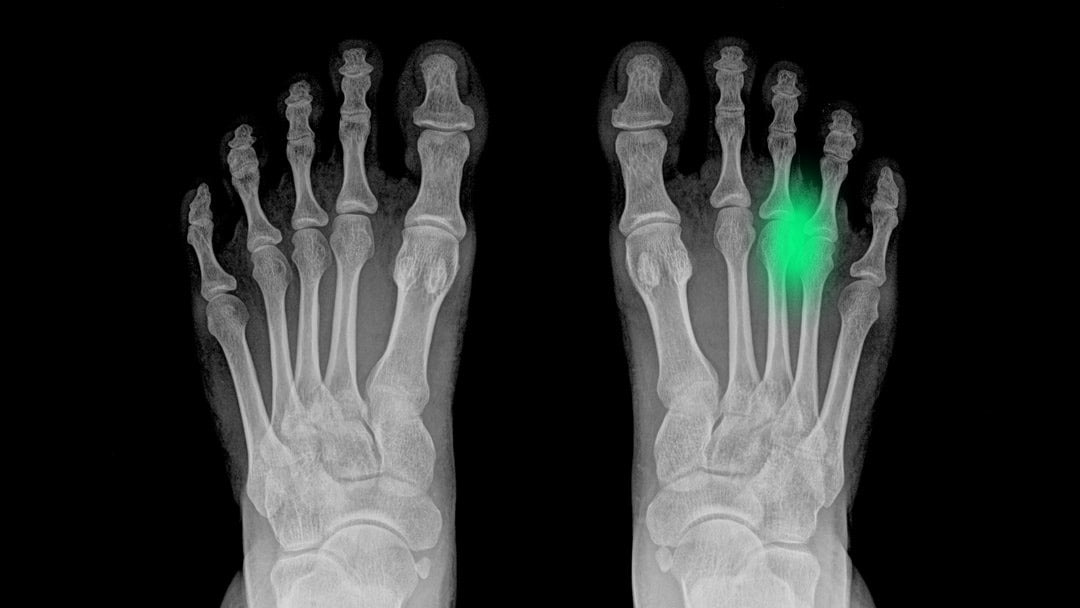Neuroma de Morton: causas, síntomas y tratamiento