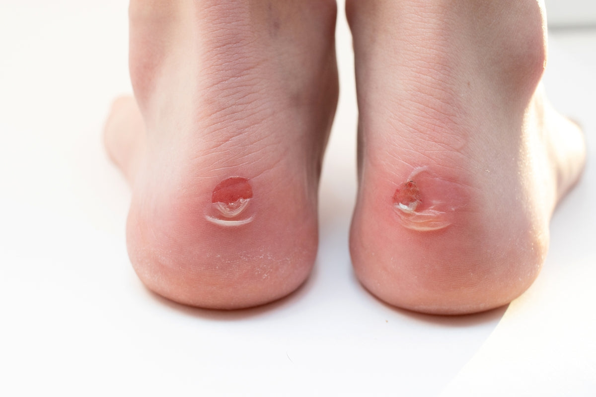 Cómo tratar y prevenir las ampollas en los pies: guía práctica